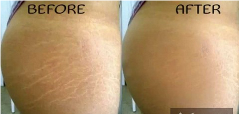 Язралтыг гэрийн аргаар 6 долоо хоногт арилгах боломжтой